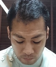 9か月後（頭頂部）