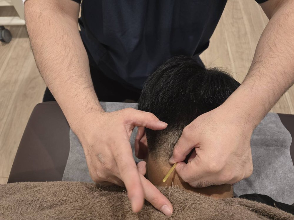 首すじへの鍼施術(院長の手元)